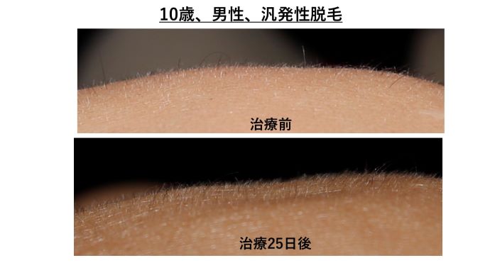 円形脱毛症　病院